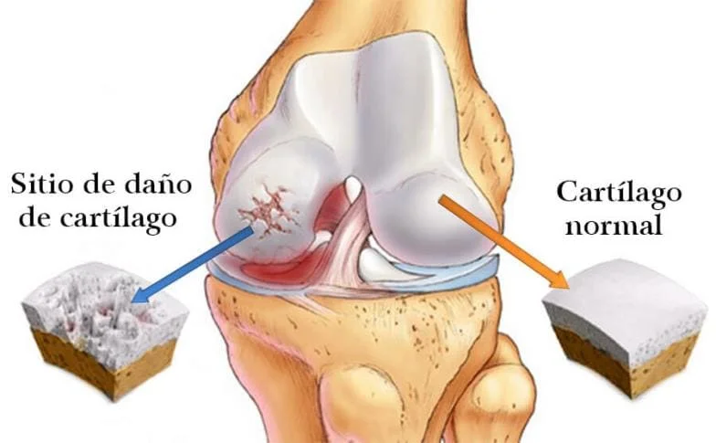 Comparación entre cartílago dañado y cartílago sano — Duston Gel se aplica directamente sobre la zona de dolor para entregar alivio térmico y antiinflamatorio